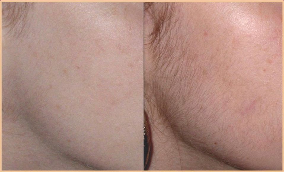 IPL haire removal device (corps, visage, mailot, aisselles)